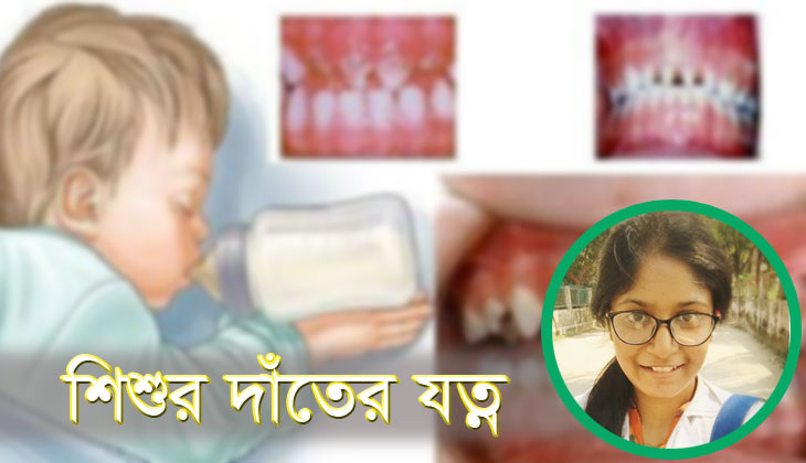 শিশুর দুধ দাঁতের যত্ন