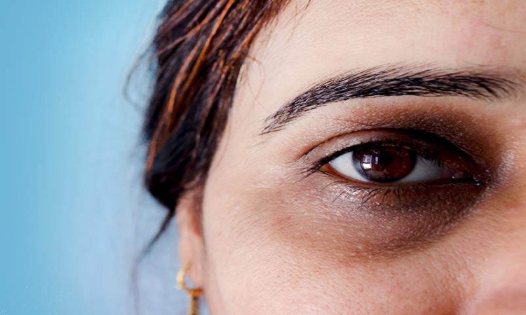 চোখের নিচের কালো দাগ দূর করার উপায়