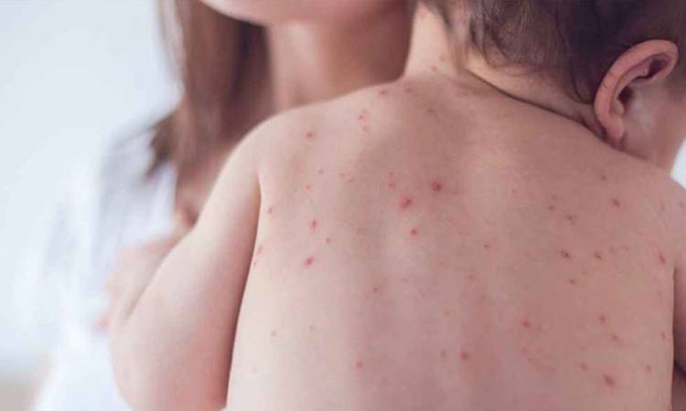 বাবা-মায়ের ৭ ভুলে হাম নিয়ে হতে পারে মারাত্মক বিপদ