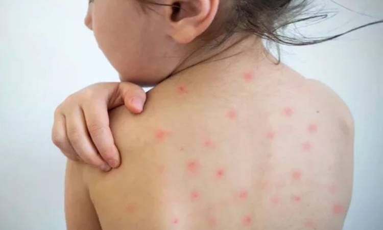 দেশে বাড়ছে হামের প্রকোপ: জেনে নিন সংক্রমণের লক্ষণ ও চিকিৎসা