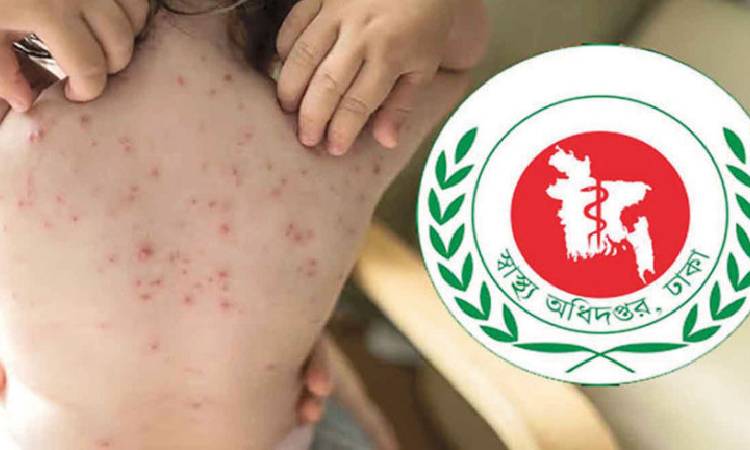 হাম উপসর্গে ৩ জনের মৃত্যু
